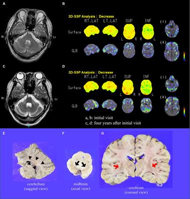 Neuropathological features of levodopa-responsive parkinsonism in multiple system atrophy: an autopsy case report and comparative neuropathological study